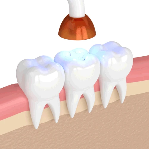 Dental Fillings and Sealants