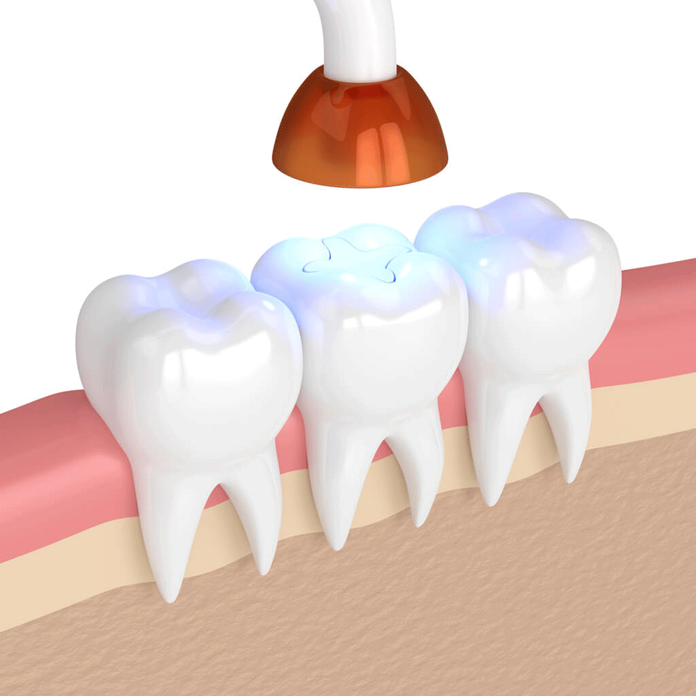 Dental Fillings and Sealants