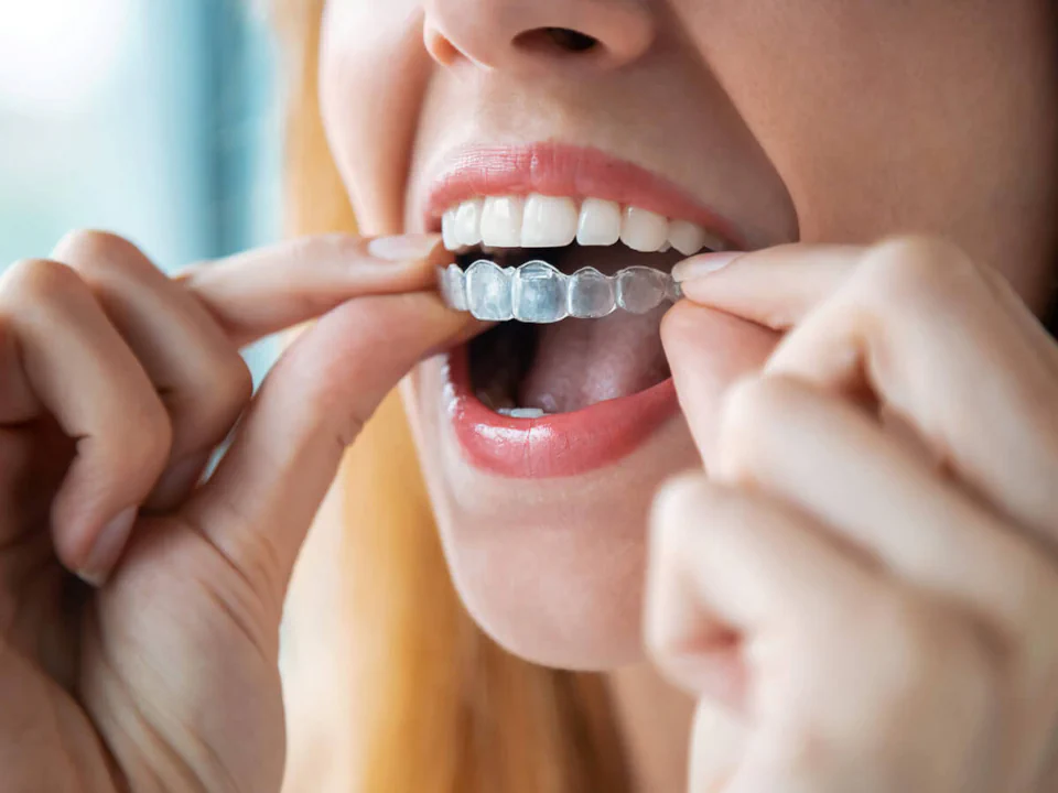 Invisalign®