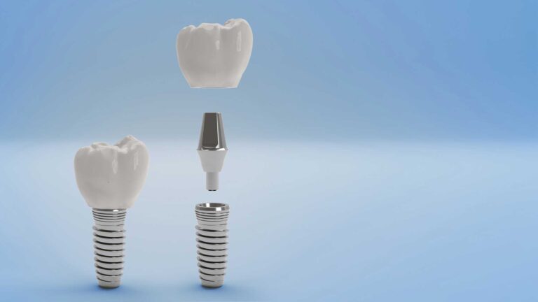 The image illustrates the components of a dental implant, including the crown, abutment, and implant screw. It visually explains how these parts connect to restore a missing tooth, emphasizing the stability and integration of the implant within the jawbone.
