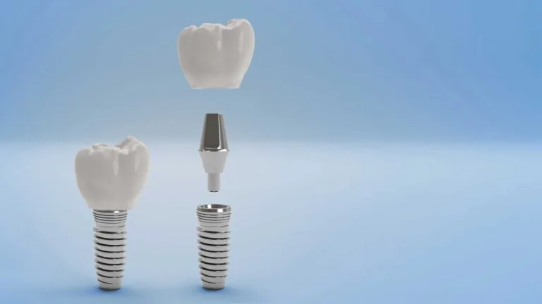 The image illustrates the components of a dental implant, including the crown, abutment, and implant screw. It visually explains how these parts connect to restore a missing tooth, emphasizing the stability and integration of the implant within the jawbone.