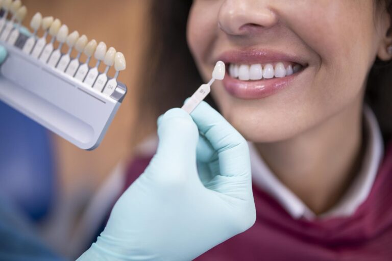 The image shows a close-up of a dental professional wearing blue gloves holding a shade guide with two dental veneers or crowns. The shade guide is being used to match the color of the veneers or crowns to the patient's natural teeth.