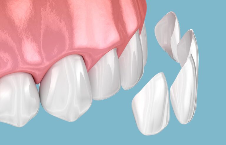 The image depicts dental veneers being applied to a set of teeth, showing separate veneer pieces to the side to illustrate the attachment process. The close-up emphasizes the cosmetic procedure that enhances the teeth's appearance by covering the front surface with thin, custom-made shells.
